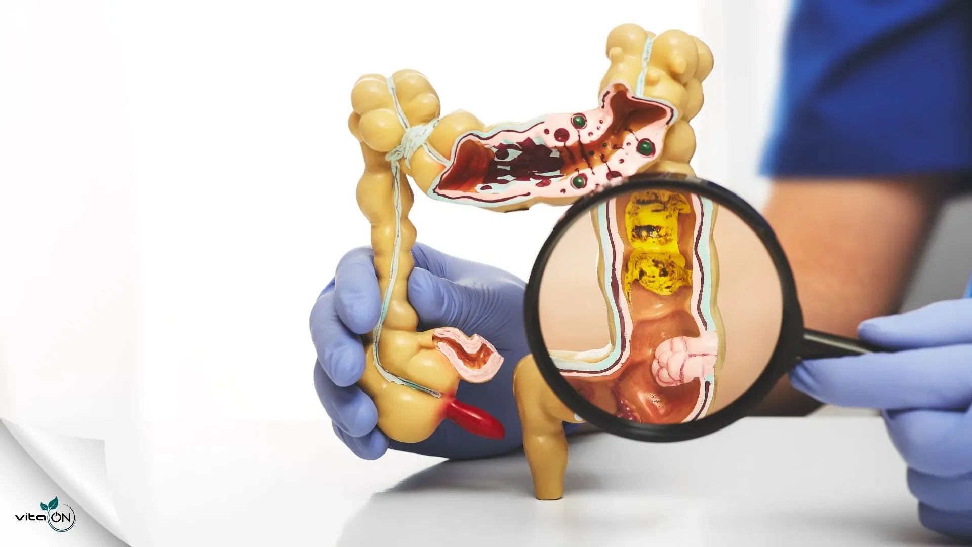 Qual è il miglior probiotico per il colon?