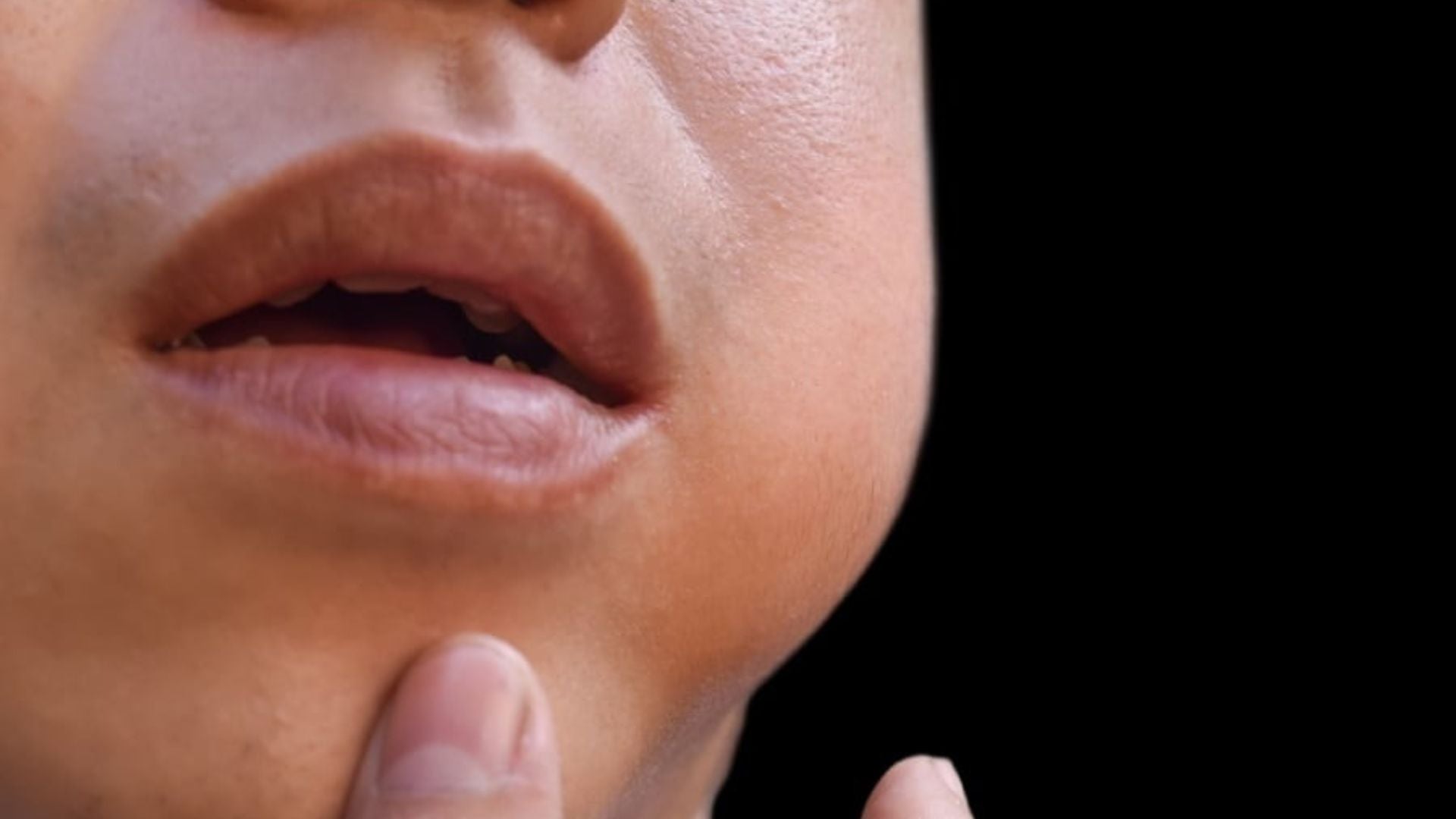 Заушка (Епидемичен паротит): Симптоми и лечение